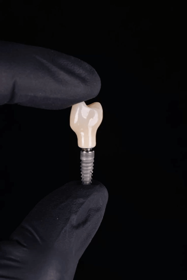 Implant dentaire