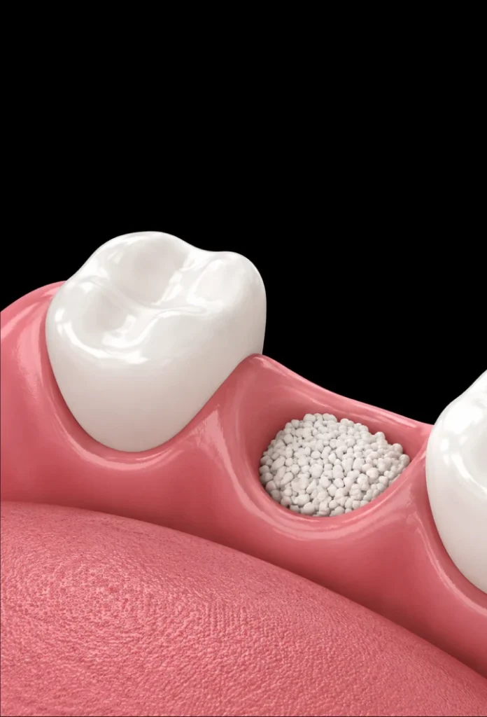 Greffe osseuse et sinus lift
