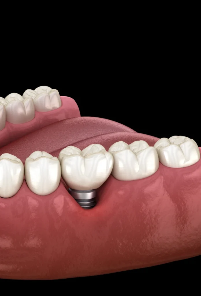 Pose d&rsquo;un implant dentaire