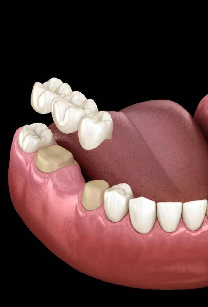 Remplacer une ou plusieurs dents : préserver l’équilibre du sourire